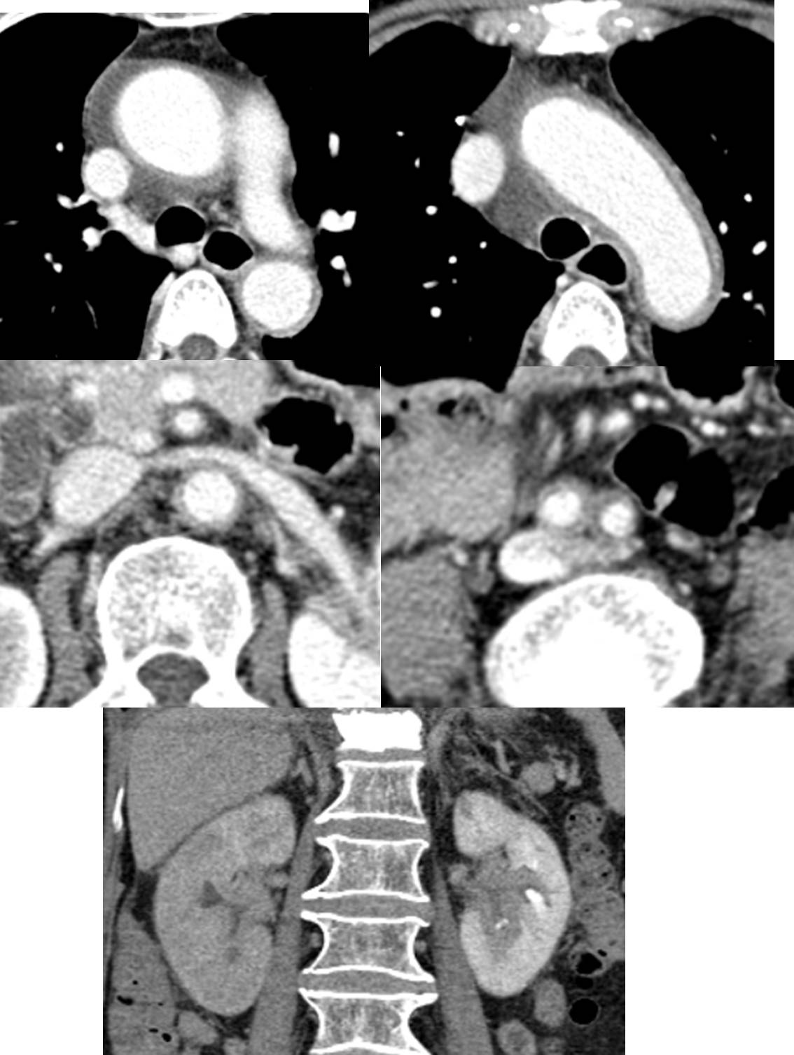 F/73,  Dyspnea on exertion (a few months)